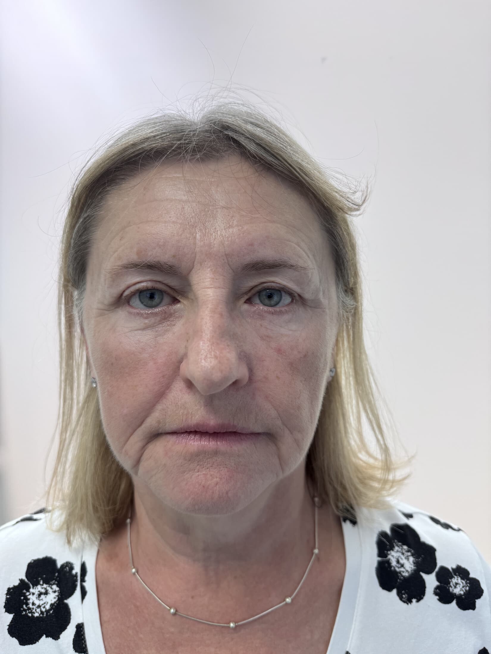 8.5 months post-treatment lower OFA-Bleph support and contour educational example at EyeFACE Institute Toronto