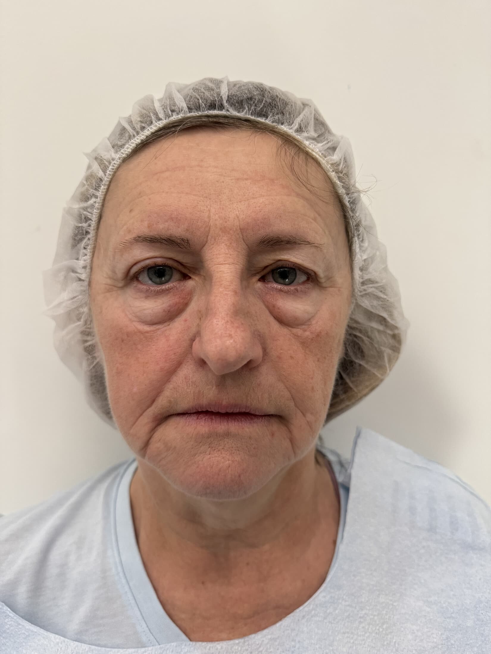 pre-treatment lower OFA-Bleph support and contour educational example at EyeFACE Institute Toronto