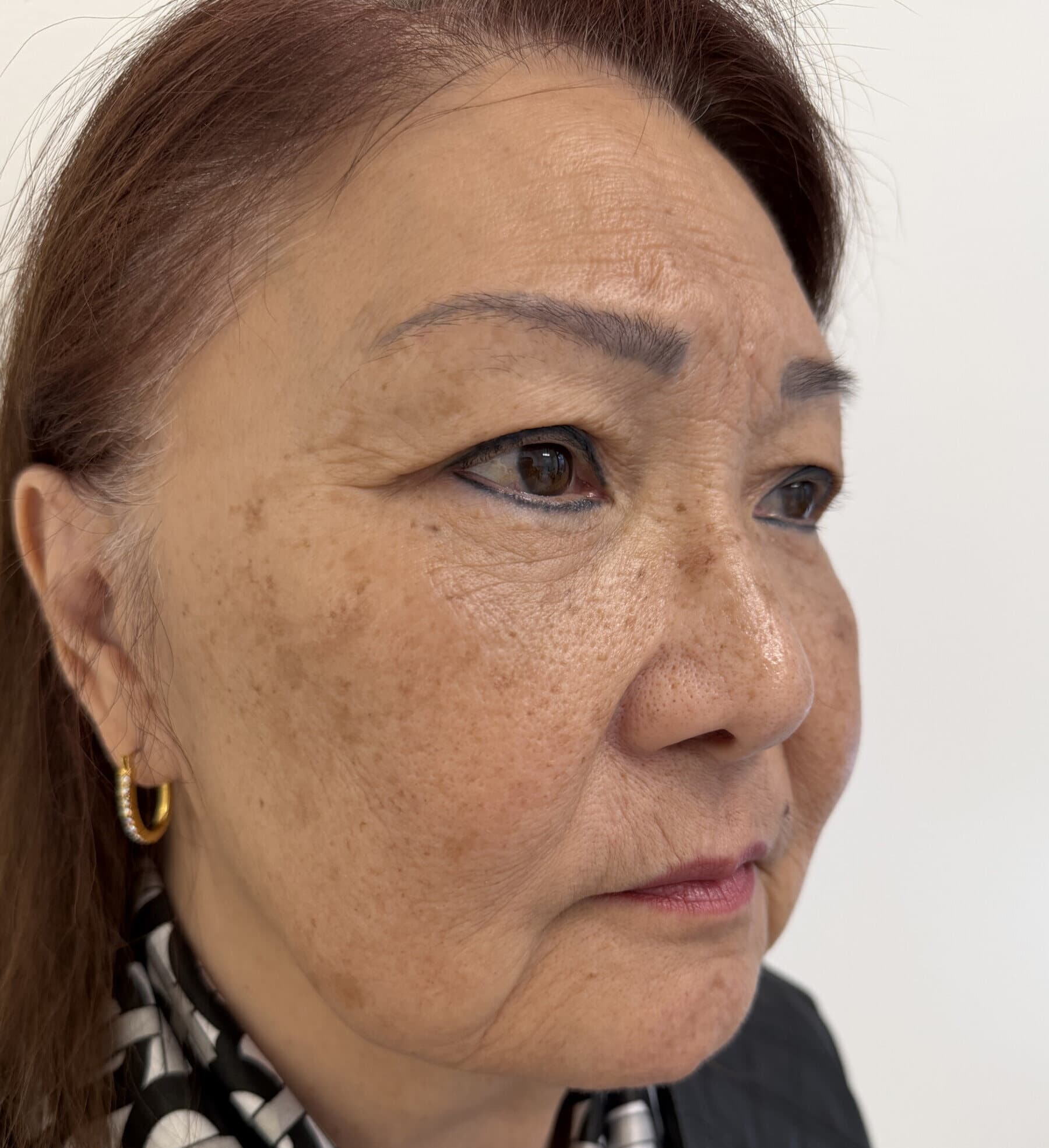 Case 002 5 months post-treatment oblique hairline-to-chin view for Four-lid OFA-Bleph™ with ptosis repair and RERF-M support at EyeFACE Institute Toronto