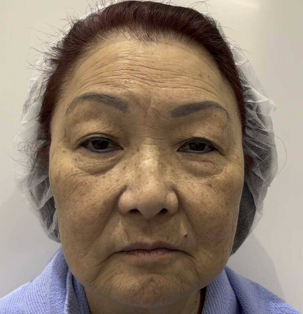 Case 002 pre-treatment frontal hairline-to-chin view for Four-lid OFA-Bleph™ with ptosis repair and RERF-M support at EyeFACE Institute Toronto