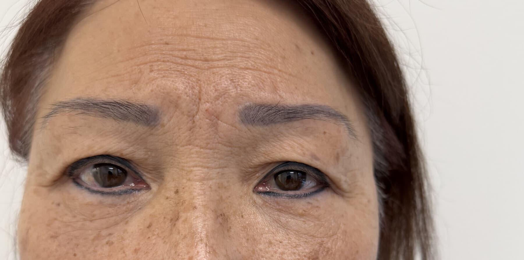 5 months post-treatment OFA-Bleph and RERF-M eyelid architecture case example at EyeFACE Institute Toronto