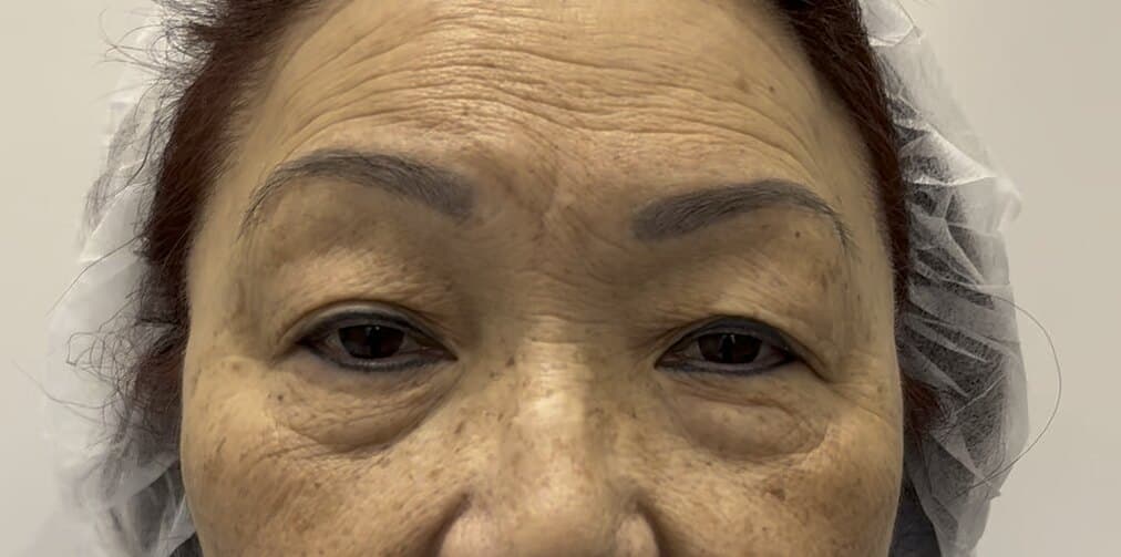 pre-treatment view OFA-Bleph and RERF-M eyelid architecture case example at EyeFACE Institute Toronto
