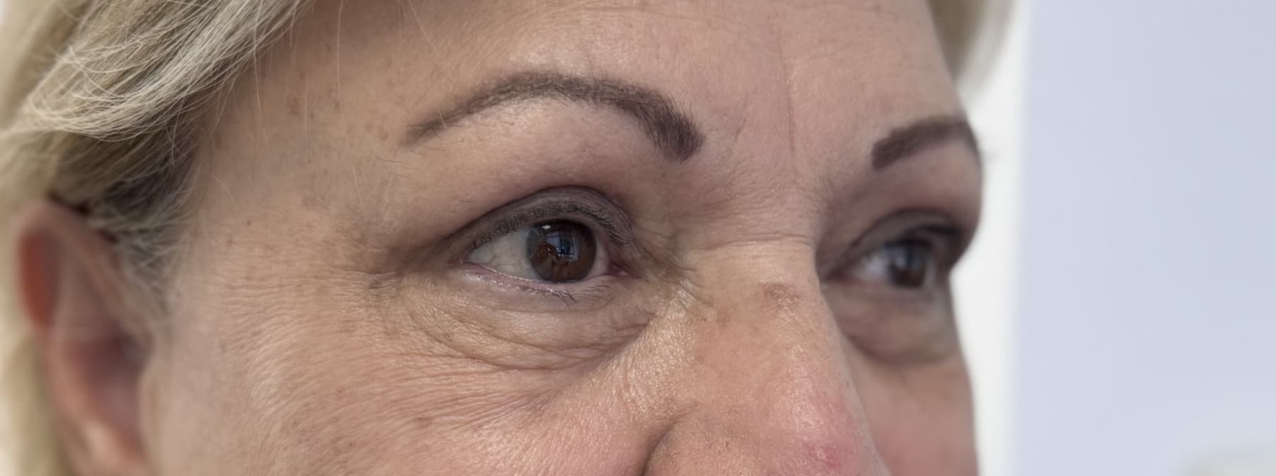 Case 003 3 months post-treatment right oblique periocular view for Upper OFA-Bleph™ with conservative periocular presentation at EyeFACE Institute Toronto