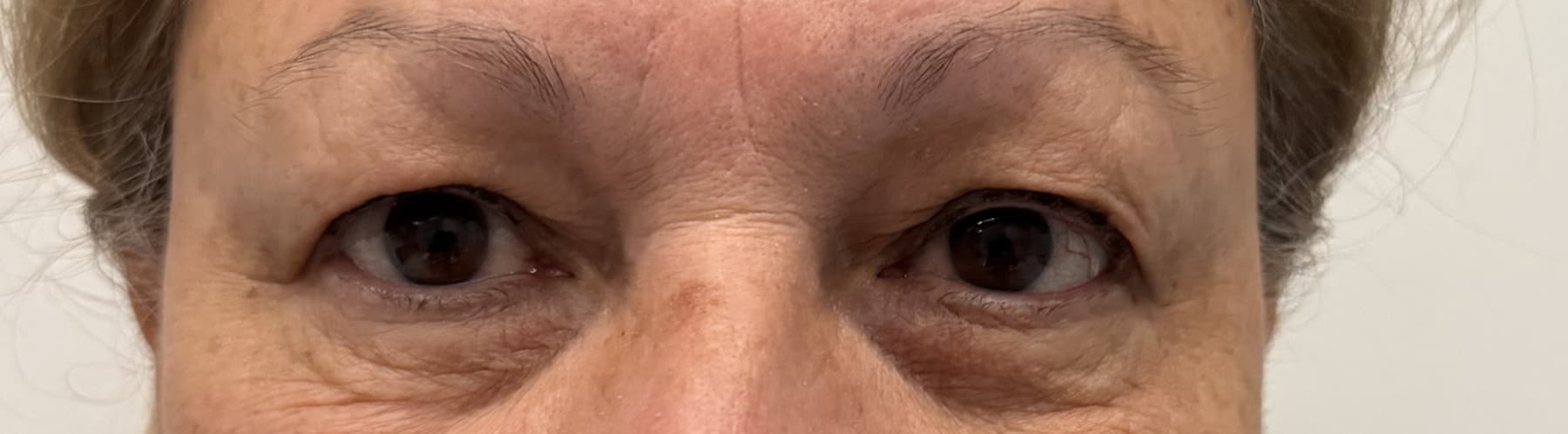 Case 003 pre-treatment frontal periocular view for Upper OFA-Bleph™ with conservative periocular presentation at EyeFACE Institute Toronto