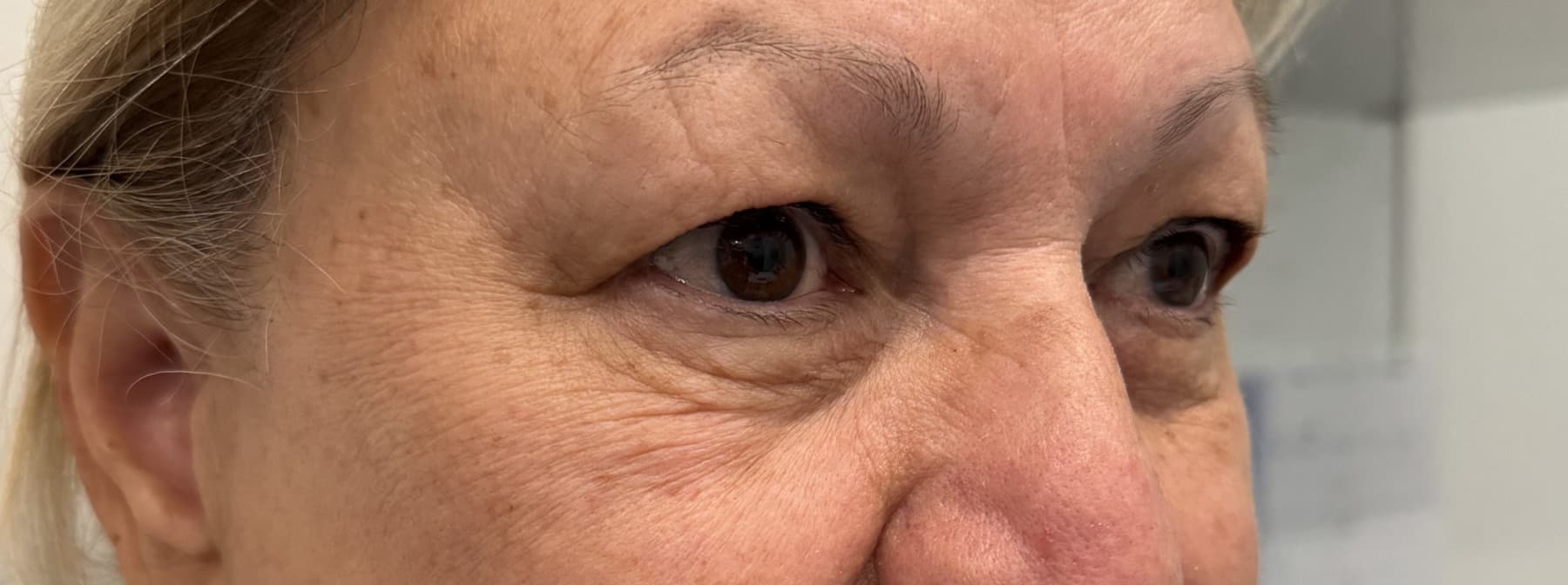 Case 003 pre-treatment right oblique periocular view for Upper OFA-Bleph™ with conservative periocular presentation at EyeFACE Institute Toronto